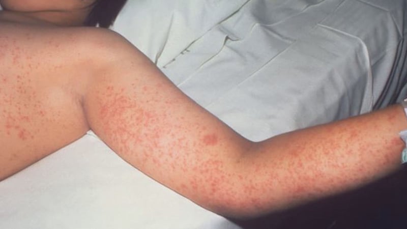 The first measles death has been confirmed in Lubbock as cases continue to spread around the...